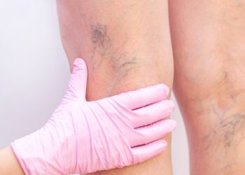 Varicose Vein Specialist Focused on Leg Health and Comfort