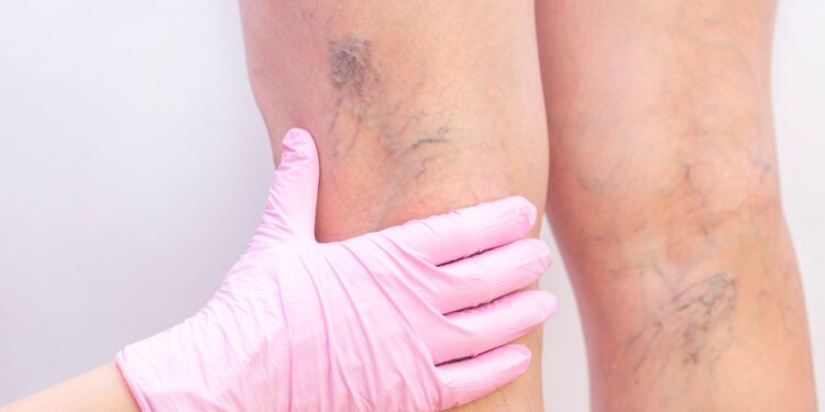 Varicose Vein Specialist Focused on Leg Health and Comfort