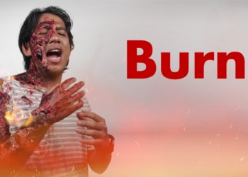 Workplace Burn Injuries: Causes, OSHA Violations & Legal Compensation (2025
Guide)