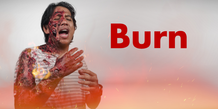 Workplace Burn Injuries: Causes, OSHA Violations & Legal Compensation (2025
Guide)