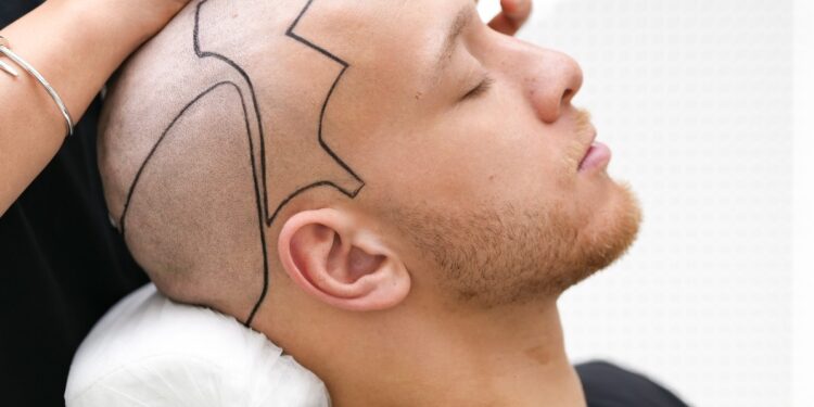 Hair Transplant Cost Turkey , Pay for Outcomes, Not Hype